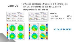 Refração:
•  OD: -3,25 20/20
•  OE: -1,00. -1,75 95 20/20
O QUE FAZER?
Caso 06
•  30 anos, ceratocone frusto em OD e incipiente
em OE, intolerante ao uso de LC, queria
indepêndencia dos óculos
 