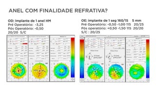 ANEL COM FINALIDADE REFRATIVA?
OD: Implante de 1 anel HM
Pré Operatório: -3,25
Pós Operatório: -0,50
20/20 S/C
OE: implante de 1 seg 160/15 5 mm
Pré Operatório: -0,50 -1,00 115 20/25
Pós operatório: +0,50 -1,50 115 20/20
S/C : 20/25
 