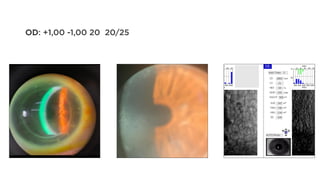 OD: +1,00 -1,00 20 20/25
 