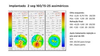 Implantado 2 seg 160/15-25 assiméricos
Olho esquerdo:
Pré: -2,25 -5,75 170 20/20
Pós: -1,50 -1,50 20 20/20
Refração final:
OD: +0,25 -1,00 20 20/20
OE: -1,50 -1,50 20 20/20
Após tratamento rejeição e
pós anel de OE:
S/C
OD: 20/20 para longe
OE: J1para perto
 