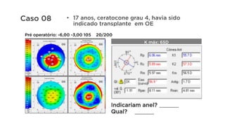 •  17 anos, ceratocone grau 4, havia sido
indicado transplante em OE
Pré operatório: -6,00 -3,00 105 20/200
K máx: 65D
Indicariam anel?
Qual?
.................
.................
Caso 08
 