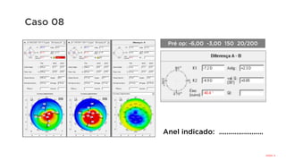 Caso 08
Anel indicado: .......................
Pré op: -6,00 -3,00 150 20/200
R:	320/25	
 