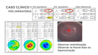 CASO CLÍNICO 1
PÓS OPERATÓRIO
Observar centralização
Observar se houve hipo ou
hipercorreção
Pós operatório: Pré operatório: Valor diferencial
 