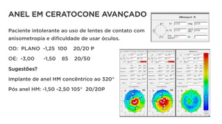 ANEL EM CERATOCONE AVANÇADO
Paciente intolerante ao uso de lentes de contato com
anisometropia e dificuldade de usar óculos.
OD: PLANO -1,25 100 20/20 P
OE: -3,00 -1,50 85 20/50
Sugestões?
Implante de anel HM concêntrico ao 320°
Pós anel HM: -1,50 -2,50 105° 20/20P
 