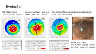 Evolução:
RESULTADO FINAL:
OD: PLANO -1,25 100 20/20
OE: -1,50 -2,50 105 20/20P
PRÉ OPERATÓRIO:
-7,00 -3,00 150 20/200
PÓS OPERATÓRIO 1 SEG 320°
-4,00 -1,50 85 20/50
PÓS OPERATÓRIO: APÓS SEGUNDO SEGMENTO
-1,50 -2,50 105 20/20P
 