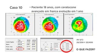 AV S/C:
20/200à 20/400
O QUE FAZER?
Caso 10 •  Paciente 18 anos, com ceratocone
avançado em franca evolução em 1 ano
 