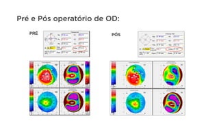 Pré e Pós operatório de OD:
PRÉ PÓS
 