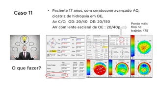 •  Paciente 17 anos, com ceratocone avançado AO,
cicatriz de hidropsia em OE,
Av C/C: OD: 20/40 OE: 20/150
AV com lente escleral de OE : 20/40p
O que fazer?
Ponto mais
fino no
trajeto: 475
Caso 11
 
