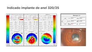 Indicado implante de anel 320/25
 