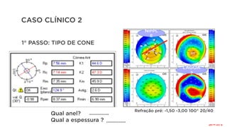 CASO CLÍNICO 2
Qual anel?
Qual a espessura ?
NIPPL
E
LAGOA
?
Refração pré: -1,50 -3,00 100° 20/40
.................
.................
1° PASSO: TIPO DE CONE
R:
210°
ou
320°
 