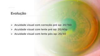 Evolução
Ø  Acuidade visual com correção pré op: 20/150
Ø  Acuidade visual com lente pré op: 20/40p
Ø  Acuidade visual com lente pós op: 20/30
 