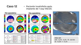 •  Paciente insatisfeita após
implante de 1 seg 140/25.
PÓS OP:
OE: -4,75 -3,75 75 20/50
Q: -0,29 à -0,29
Pós operatório:
Caso 12
Pré operatório:
 