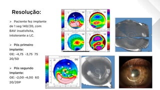 Resolução:
Ø  Paciente fez implante
de 1 seg 140/20, com
BAV insatisfeita,
intolerante a LC.
Ø  Pós primeiro
implante:
OE: -4,75 -3,75 75
20/50
Ø  Pós segundo
Implante:
OE: -2,00 -4,00 60
20/20P
 