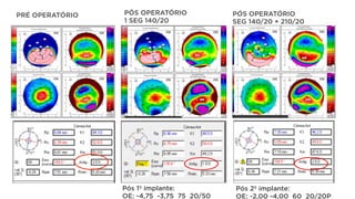 Pós 2º implante:
OE: -2,00 -4,00 60 20/20P
Pós 1º implante:
OE: -4,75 -3,75 75 20/50
PRÉ OPERATÓRIO PÓS OPERATÓRIO
1 SEG 140/20
PÓS OPERATÓRIO
SEG 140/20 + 210/20
 