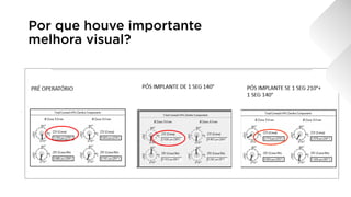 Por que houve importante
melhora visual?
 