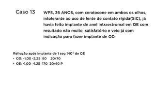 Refração após implante de 1 seg 140° de OE
•  OD: -1,00 -2,25 80 20/70
•  OE: -1,00 -1,25 170 20/40 P
WPS, 36 ANOS, com ceratocone em ambos os olhos,
intolerante ao uso de lente de contato rígida(SIC), já
havia feito implante de anel intraestromal em OE com
resultado não muito satisfatório e veio já com
indicação para fazer implante de OD.
Caso 13
 