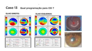 .
OLHO DIREITO: OLHO ESQUERDO:
Qual programação para OD ?
Caso 13
 