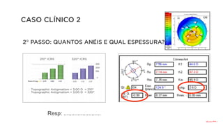 CASO CLÍNICO 2
2° PASSO: QUANTOS ANÉIS E QUAL ESPESSURA?
Resp: ........................
1
seg
210°/20
 