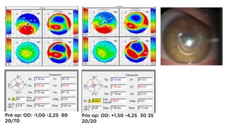 Pré op: OD: -1,00 -2,25 80
20/70
Pós op: OD: +1,50 -4,25 30 35
20/20
 
