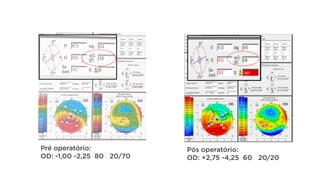 Pré operatório:
OD: -1,00 -2,25 80 20/70
Pós operatório:
OD: +2,75 -4,25 60 20/20
 