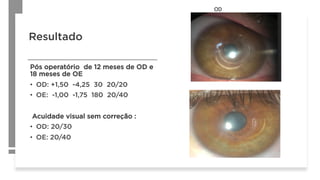 Resultado
Pós operatório de 12 meses de OD e
18 meses de OE
•  OD: +1,50 -4,25 30 20/20
•  OE: -1,00 -1,75 180 20/40
Acuidade visual sem correção :
•  OD: 20/30
•  OE: 20/40
OD	
 