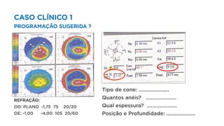 CASO CLÍNICO 1
PROGRAMAÇÃO SUGERIDA ?
Tipo de cone: ......................
Quantos anéis? ......................
Qual espessura? ......................
Posição e Profundidade: .....................
REFRAÇÃO:
OD: PLANO -1,75 75 20/20
OE: -1,00 -4,00 105 20/60
 
