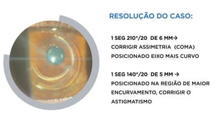 RESOLUÇÃO DO CASO:
1 SEG 210°/20 DE 6 MMà
CORRIGIR ASSIMETRIA (COMA)
POSICIONADO EIXO MAIS CURVO
1 SEG 140°/20 DE 5 MM à
POSICIONADO NA REGIÃO DE MAIOR
ENCURVAMENTO, CORRIGIR O
ASTIGMATISMO
 
