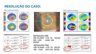 RESOLUÇÃO DO CASO:
REFRAÇÃO PRÉ:
OD: PLANO -1,75 75 20/20
OE: -1,00 -4,00 105
20/60
REFRAÇÃO PÓS:
OD: PLANO -1,75 75 20/20
OE: +1,50 -1,00 135 20/25
 