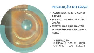 Ø  REFRAÇÃO
OD: PLANO -1,75 75 20/20
OE: +1,50 -1,00 135 20/25
RESOLUÇÃO DO CASO:
Ø PACIENTE SATISFEITO COM O
ÓCULOS
Ø TEM A LC GELATINOSA COMO
OPÇÃO
Ø ESTÁVEL HÁ 1 ANO, MANTÉM
ACOMPANHAMENTO A CADA 4
MESES
 