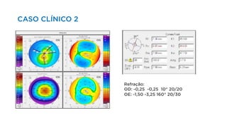 Refração:
OD: -0,25 -0,25 10° 20/20
OE: -1,50 -3,25 160° 20/30
CASO CLÍNICO 2
 