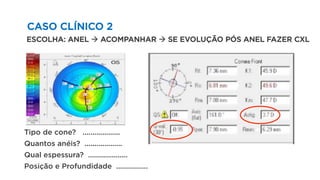 CASO CLÍNICO 2
ESCOLHA: ANEL à ACOMPANHAR à SE EVOLUÇÃO PÓS ANEL FAZER CXL
Tipo de cone? ...................
Quantos anéis? ...................
Qual espessura? ....................
Posição e Profundidade ................
 