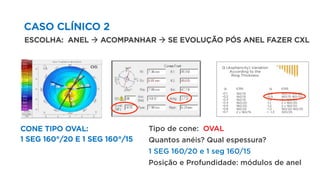 CASO CLÍNICO 2
CONE TIPO OVAL:
1 SEG 160°/20 E 1 SEG 160°/15
ESCOLHA: ANEL à ACOMPANHAR à SE EVOLUÇÃO PÓS ANEL FAZER CXL
Tipo de cone: OVAL
Quantos anéis? Qual espessura?
1 SEG 160/20 e 1 seg 160/15
Posição e Profundidade: módulos de anel
 
