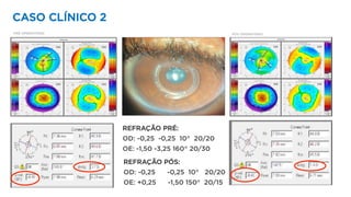 CASO CLÍNICO 2
REFRAÇÃO PRÉ:
OD: -0,25 -0,25 10° 20/20
OE: -1,50 -3,25 160° 20/30
REFRAÇÃO PÓS:
OD: -0,25 -0,25 10° 20/20
OE: +0,25 -1,50 150° 20/15
PRÉ OPERATÓRIO PÓS OPERATÓRIO
 