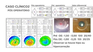 Pré OE: -1,50 -3,00 100 20/40
Pós OE: -1,00 -3,25 155 20/25
Observar se houve hipo ou
hipercorreção
Pós operatório: Pré operatório: Valor diferencial
CASO CLÍNICO2
PÓS OPERATÓRIO
 
