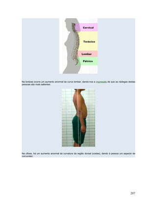 Na lordose ocorre um aumento anormal da curva lombar, dando-nos a impressão de que as nádegas destas
pessoas são mais salientes:




Na cifose, há um aumento anormal da curvatura da região dorsal (costas), dando à pessoa um aspecto de
corcundez:




                                                                                                207
 