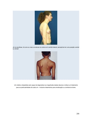 Já na escoliose, há uma ou mais curvaturas na coluna em sentido lateral, perceptível em uma posição ventral
ou dorsal:




  Um médico ortopedista será capaz de diagnosticar as magnitudes destes desvios e indicar um tratamento
     para as particularidades de cada um – inclusive tratamentos para erradicação ou controle de dores.




                                                                                                          208
 