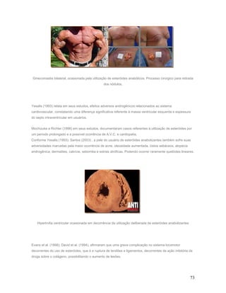 Ginecomastia bilateral, ocasionada pela utilização de esteróides anabólicos. Processo cirúrgico para retirada
                                                 dos nódulos.




Yesalis (1993) relata em seus estudos, efeitos adversos androgênicos relacionados ao sistema
cardiovascular, constatando uma diferença significativa referente à massa ventricular esquerda e espessura
do septo intraventricular em usuários.


Mochizuke e Richter (1998) em seus estudos, documentaram casos referentes à utilização de esteróides por
um período prolongado e a possível ocorrência de A.V.C. e cardiopatia.
Conforme Yesalis (1993); Santos (2003) , a pele do usuário de esteróides anabolizantes também sofre suas
adversidades marcadas pela maior ocorrência de acne, oleosidade aumentada, cistos sebáceos, alopécia
androgênica, dermatites, calvície, seborréia e estrias atróficas. Podendo ocorrer raramente quelóides lineares.




   Hipertrofia ventricular ocasionada em decorrência da utilização deliberada de esteróides anabolizantes




Evans et al. (1998); David et al. (1994), afirmaram que uma grave complicação no sistema locomotor
decorrentes do uso de esteróides, que é a ruptura de tendões e ligamentos, decorrentes da ação inibitória da
droga sobre o colágeno, possibilitando o aumento de lesões.




                                                                                                            73
 