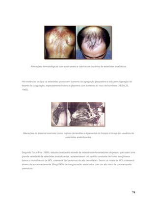 Alterações dermatológicas com acne severa e calvície em usuários de esteróides anabólicos




Há evidências de que os esteróides promovem aumento da agregação plaquetária e induzem a geração de
fatores da coagulação, especialmente trobina e plasmina com aumento do risco de trombose (YESALIS,
1993).




 Alterações no sistema locomotor como, ruptura de tendões e ligamentos do bíceps e tríceps em usuários de
                                         esteróides anabolizantes.




Segundo Fox e Fos (1989), estudos realizados através de relatos onde levantadores de pesos, que usam uma
grande variedade de esteróides anabolizantes, apresentavam um padrão constante de níveis sangüíneos
baixos a muito baixos de HDL colesterol (lipoproteínas de alta densidade). Sendo os níveis de HDL-colesterol
abaixo de aproximadamente 38mg/100ml de sangue estão associados com um alto risco de coronariopatia
prematura.




                                                                                                          74
 