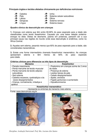 Disciplina: Avaliação Nutricional. Prof. Msc. Luciano Alex Santos 70
Principais órgãos e tecidos afetados clinicamente por deficiências nutricionais
Cabelos Unha
Pele Sistema celular subcutâneo
Lábios Olhos
Gengivas Sistema nervoso
Língua Sistema ósseo
Quadro clínico da desnutrição em crianças
1. Crianças com edema que têm entre 60-80% do peso esperado para a idade são
classificadas como tendo Kwashiorkor. Causado por uma baixa relação proteína-
energia na dieta. Dietas de desmame, pobres em proteínas, parecem ser a sua
principal causa nas regiões do mundo onde essa desnutrição é endêmica, como na
África Central.
2. Aquelas sem edema, pesando menos que 60% de peso esperado para a idade, são
consideradas marasmáticas.
3. Existe uma forma intermediária chamada Kwashiorkor marasmático. As crianças
apresentam edema e têm menos de 60% do peso esperado
para idade.
Critérios clínicos para diferenciar os três tipos de desnutrição
Marasmo Kwashiorkor
- Parada crescimento
- Perda marcante de tecido muscular
- Perda marcante de tecido adiposo
subcutâneo
- Sem edema
- Cabelos escassos, quebradiços e às
vezes despigmentados
- Criança, normalmente, irritadiça e
apática
- Predomino em crianças acima de 2 anos
de idade
- Presença de edema
- Lesões típicas de pele
- Cabelo despigmentados
- Apatia, anorexia
- Fígado gorduroso e aumentado
- Hipoalbuminemia
Kwashiorkor marasmático
- Apresenta os sintomas de marasmo mais edema
Fonte: www.desnutricao.org.br
 
