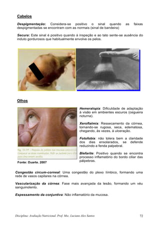 Disciplina: Avaliação Nutricional. Prof. Msc. Luciano Alex Santos 72
Cabelos
Despigmentação: Considera-se positivo o sinal quando as faixas
despigmentadas se encontram com as normais (sinal de bandeira)
Secura: Este sinal é positivo quando à inspeção e ao tato sente-se ausência do
induto gordurosos que habitualmente envolve os pelos.
Olhos
Hemeralopia: Dificuldade de adaptação
à visão em ambientes escuros (cegueira
noturna).
Xeroftalmia: Ressecamento da córnea,
tornando-se rugosa, seca, edematosa,
chegando, às vezes, à ulceração.
Fotofobia: não tolera bem a claridade
dos dias ensolarados, se defende
reduzindo a fenda palpebral.
Blefarite: Positivo quando se encontra
processo inflamatório do bordo ciliar das
pálpebras.
Congestão circum-corneal: Uma congestão do plexo Iímbico, formando uma
rede de vasos capilares na córnea.
Vascularização da córnea: Fase mais avançada da lesão, formando um véu
sanguinolento.
Espessamento da conjuntiva: Não inflamatório da mucosa.
Fonte: Duarte, 2007
 