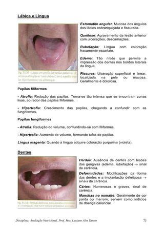 Disciplina: Avaliação Nutricional. Prof. Msc. Luciano Alex Santos 73
Lábios e Língua
Estomatite angular: Mucosa dos ângulos
dos lábios esbranquiçada e fissurada.
Queilose: Agravamento da lesão anterior
com ulcerações, descamações.
Rubefação: Língua com coloração
fracamente escarlate.
Edema: Tão nítido que permite a
impressão dos dentes nos bordos laterais
da língua.
Fissuras: Ulceração superficial e linear,
localizada na pele ou mucosa.
Geralmente é dolorosa.
Papilas filiformes
- Atrofia: Redução das papilas. Torna-se tão intensa que se encontram zonas
lisas, ao redor das papilas filiformes.
- Hipertrofia: Crescimento das papilas, chegando a confundir com as
fungiformes.
Papilas fungiformes
- Atrofia: Redução do volume, confundindo-se com filiformes.
- Hipertrofia: Aumento de volume, formando tufos de papilas.
Língua magenta: Quando a língua adquire coloração purpurina (violeta).
Dentes
Perdas: Ausência de dentes com lesões
das gengivas (edema, rubefação)  sinal
de carência.
Deformidades: Modificações da forma
dos dentes e a implantação defeituosa 
sinais de carência.
Cáries: Numerosas e graves, sinal de
carência.
Manchas no esmalte: Geralmente de cor
parda ou marrom, servem como indícios
de doença carencial.
 