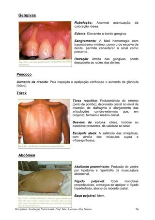 Disciplina: Avaliação Nutricional. Prof. Msc. Luciano Alex Santos 74
Gengivas
Rubefação: Anormal acentuação da
coloração rósea.
Edema: Elevando o bordo gengiva.
Sangramento: A fácil hemorragia com
traumatismo mínimo, como o de escova de
dente, permite considerar o sinal como
presente.
Retração: Atrofia das gengivas, pondo
descoberto as raízes dos dentes.
Pescoço
Aumento da tireoide: Pela inspeção e apalpação verifica-se o aumento da glândula
(bócio).
Tórax
Tórax raquítico: Protuberância do externo
(peito de pombo), depressão costaI no nível da
inserção do diafragma e alargamento das
articulações condro-externais que, em
conjunto, formam o rosário costal.
Desvios da coluna: cifose, lordose ou
escoliose presentes, dá validade ao sinal.
Escápula alada: A saliência das omoplatas,
com atrofia dos músculos supra e
infraespinhosos.
Abdômen
Abdômen proeminente: Protusão do ventre
por hipotonia e hipertrofia da musculatura
abdominal.
Fígado palpável: Com manobras
propedêuticas, consegue-se apalpar o fígado
hipertrofiado, abaixo do rebordo costal.
Baço palpável: Idem.
 
