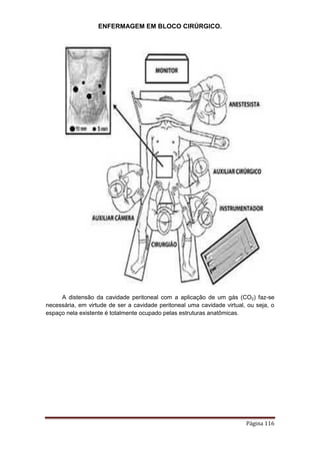 ENFERMAGEM EM BLOCO CIRÚRGICO.
Página 116
A distensão da cavidade peritoneal com a aplicação de um gás (CO2) faz-se
necessária, em virtude de ser a cavidade peritoneal uma cavidade virtual, ou seja, o
espaço nela existente é totalmente ocupado pelas estruturas anatômicas.
 