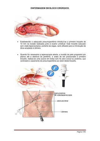ENFERMAGEM EM BLOCO CIRÚRGICO.
Página 146
 Estabelecido o adequado pneumoperitônio introduz-se o primeiro trocarte de
10 mm na incisão realizada junto à cicatriz umbilical. Este trocarte colocado
sem visão laparoscópica, portanto às cegas, será utilizado para a introdução da
ótica acoplada à câmara.
 Quando for necessária a laparoscopia aberta, a incisão da pele progredirá por
planos até a abertura do peritônio, e antes de ser posicionado o primeiro
trocarte, realiza-se uma sutura em bolsa com fio zero (vicryl ou prolene), que
controlará o vazamento do pneumoperitônio ao redor deste trocarte.
 
