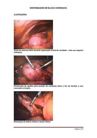 ENFERMAGEM EM BLOCO CIRÚRGICO.
Página 149
ILUSTRAÇÕES
Vista da vesícula biliar durante exploração inicial da cavidade - note seu aspecto
hidrópico
Penetração de agulha para punção do conteúdo biliar a fim de facilitar o seu
manuseio cirúrgico
Dissecção da artéria cística e ducto cístico
 