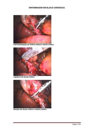 ENFERMAGEM EM BLOCO CIRÚRGICO.
Página 150
Individualização da artéria cística e ducto cístico
Ligadura do ducto cístico
Secção do ducto cístico e artéria cística
 