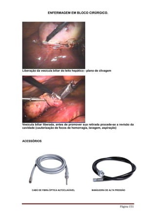 ENFERMAGEM EM BLOCO CIRÚRGICO.
Página 151
Liberação da vesícula biliar do leito hepático - plano de clivagem
Vesícula biliar liberada, antes de promover sua retirada procede-se a revisão da
cavidade (cauterização de focos de hemorragia, lavagem, aspiração)
ACESSÓRIOS
CABO DE FIBRA ÓPTICA AUTOCLAVÁVEL MANGUEIRA DE ALTA PRESSÃO
 