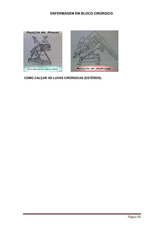 ENFERMAGEM EM BLOCO CIRÚRGICO.
Página 30
COMO CALÇAR AS LUVAS CIRÚRGICAS (ESTÉREIS).
 