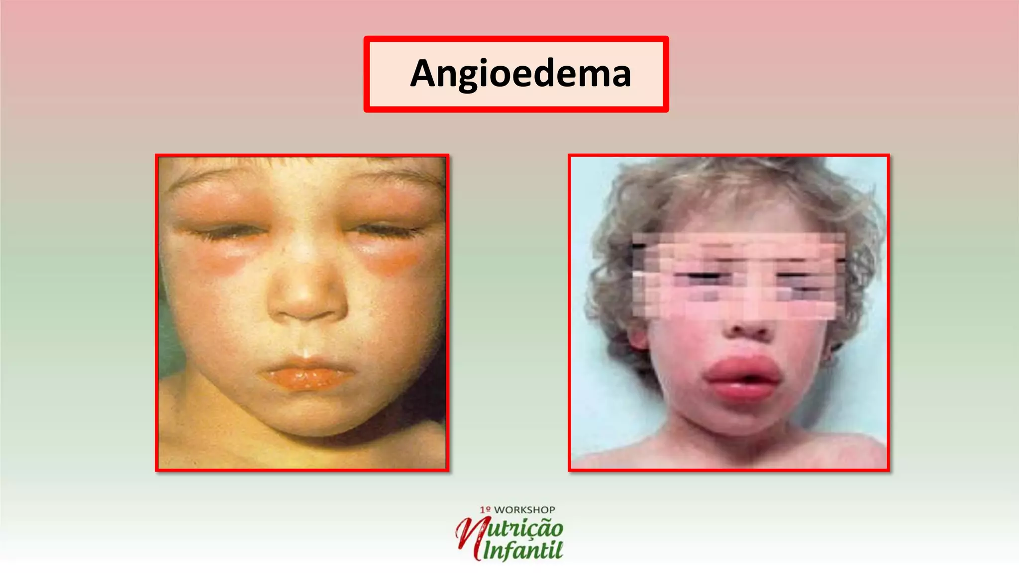 Angioedema
 