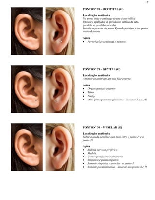 17
PONTO Nº 28 – OCCIPITAL (G)
Localização anatômica
No ponto onde o antítrago se une à anti-hélice
Utilizar o apalpador de pressão no sentido da seta,
paralelo ao pavilhão auricular
Insistir na procura do ponto. Quando positivo, é um ponto
muito doloroso
Ações
Perturbações sensitivas e motoras
PONTO Nº 29 – GENITAL (G)
Localização anatômica
Anterior ao antítrago, em sua face externa
Ações
Órgãos genitais externos
Tônus
Fadiga
Olho (principalmente glaucoma – associar 1, 21, 24)
PONTO Nº 30 – MEDULAR (G)
Localização anatômica
Sobre a cauda da hélice num raio entre o ponto 21 e o
ponto 20
Ações
Sistema nervoso periférico
Medula
Cornos posteriores e anteriores
Simpático e parassimpático
Somente simpático - associar ao ponto 3
Somente parassimpático – associar aos pontos 8 e 15
 